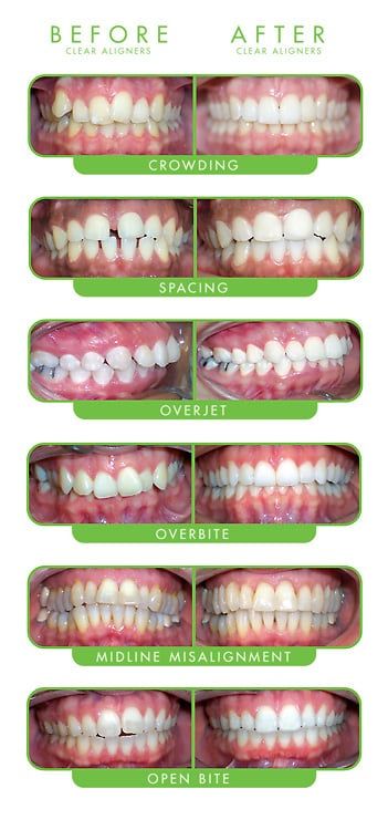 ClearCorrect Invisible Braces
