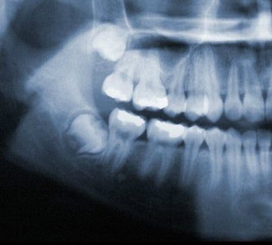 Floss & Co. - Wisdom Teeth | Chicagoland | Midway